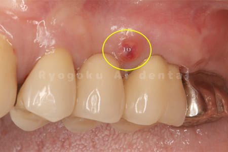 慢性根尖性歯周炎