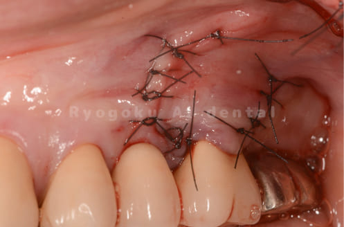 歯根端切除術術後