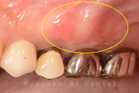 慢性根尖性歯周炎