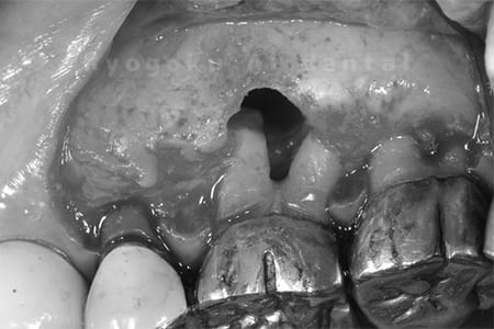 歯根端切除術の術中