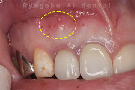 慢性根尖性歯周炎