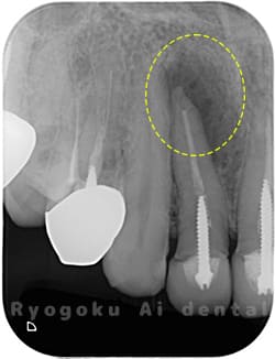 慢性根尖性歯周炎のレントゲン