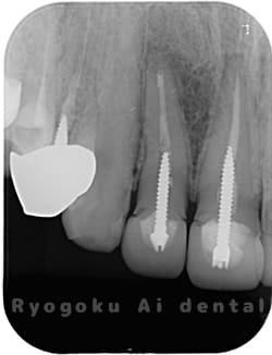 歯根端切除術の術後1年半後