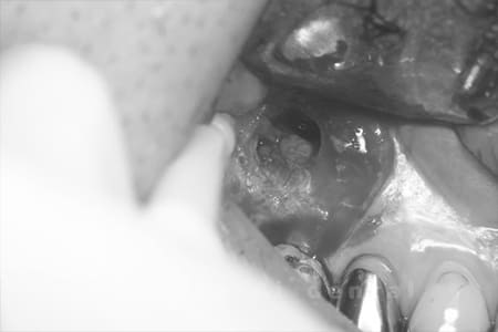 歯根端切除法術中1