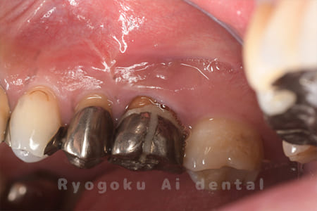 歯根端切除法術後