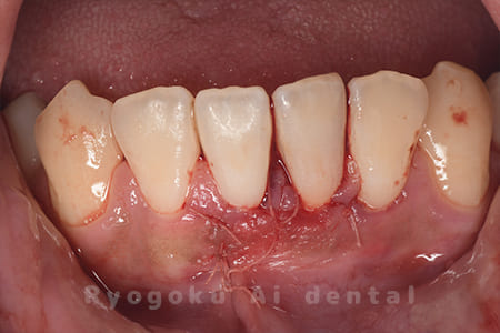 歯根端切除法術中2