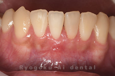 歯根端切除法術後