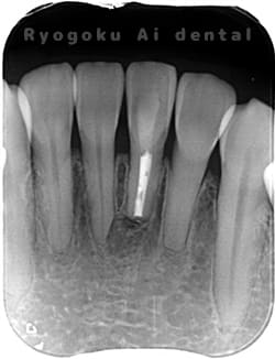 歯根端切除術の術後1年後