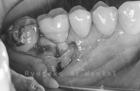 歯根端切除法術中1