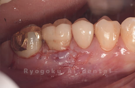 歯根端切除法術中2