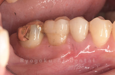 歯根端切除法術後