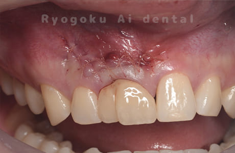 歯根端切除法術中2