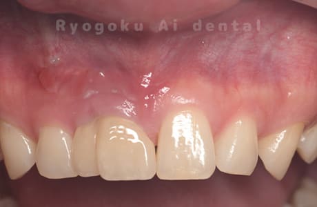 歯根端切除法術後