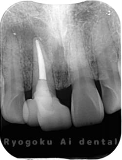 慢性根尖性歯周炎のレントゲン