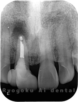 歯根端切除法の術後