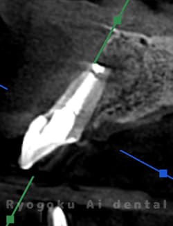 歯根端切除術後