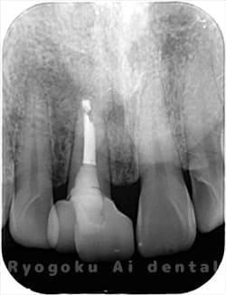 歯根端切除術術後1年