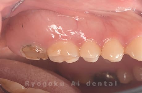 歯根嚢胞、重度カリエス