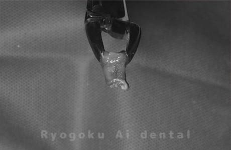 再植手術、クラウンレングスニング術中1