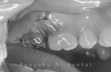 再植手術、クラウンレングスニング術中2