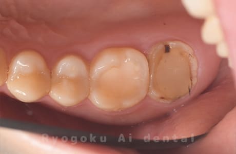 歯根嚢胞、重度カリエス