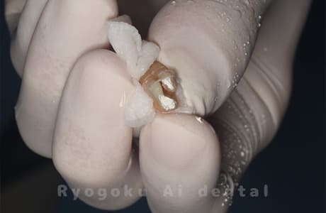 再植手術、クラウンレングスニング術中1