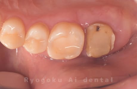 再植手術、クラウンレングスニング術後