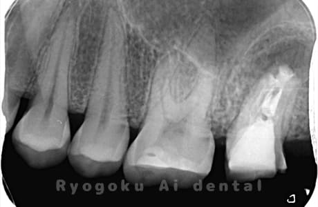 歯根嚢胞、重度カリエスのレントゲン