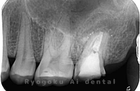 再植手術、クラウンレングスニングの術後