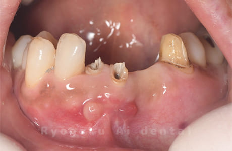 下顎前歯部歯根嚢胞