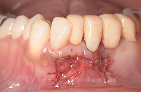 歯根端切除法術直後