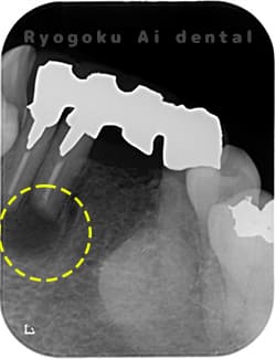 下顎前歯部歯根嚢胞のレントゲン