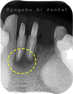 歯根端切除法の術後