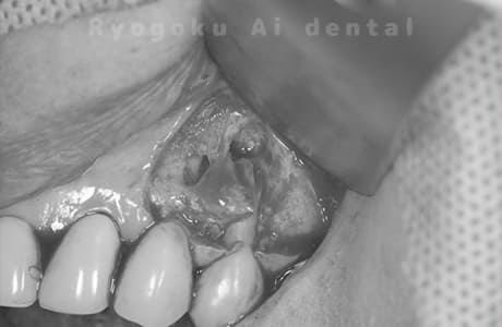 歯根端切除法術中1