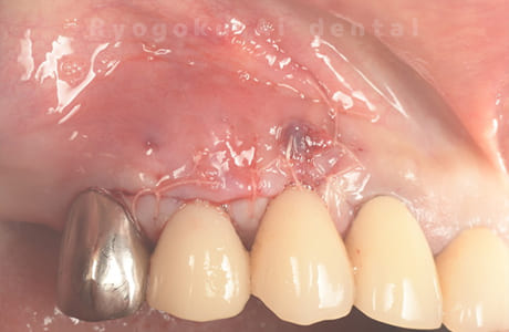 歯根端切除法術直後