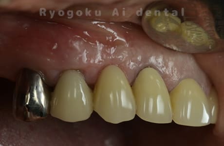 歯根端切除法術後