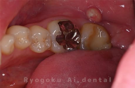 慢性根尖性歯周炎