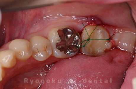 再植歯根端切除術中