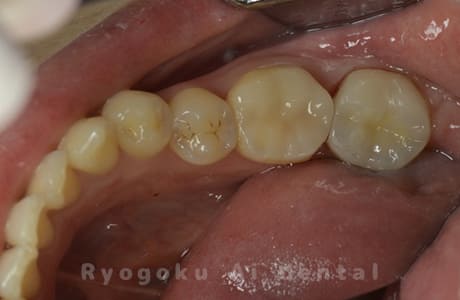 再植歯根端切除術後