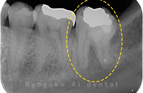慢性根尖性歯周炎