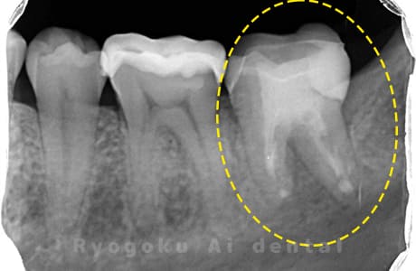 再植歯根端切除術後レントゲン