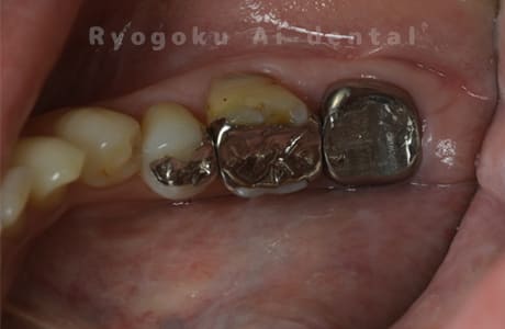 慢性根尖性歯周炎