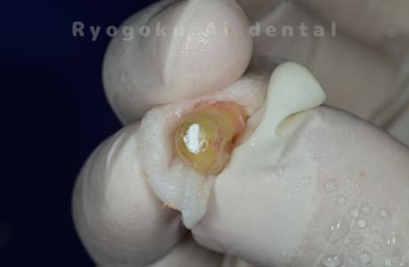 再植歯根端切除術