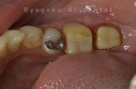 再植歯根端切除術後