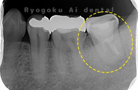 慢性根尖性歯周炎レントゲン
