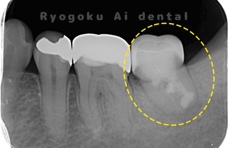 再植歯根端切除術後レントゲン