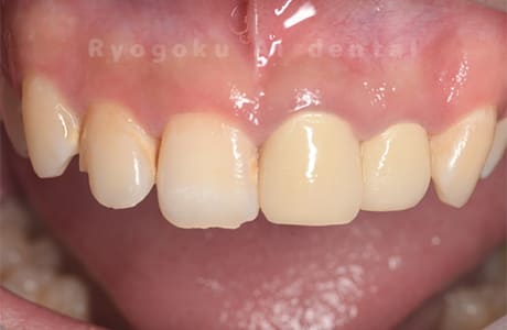 左上１、２番歯根嚢胞