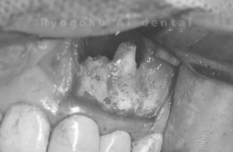 歯根端切除法術中1