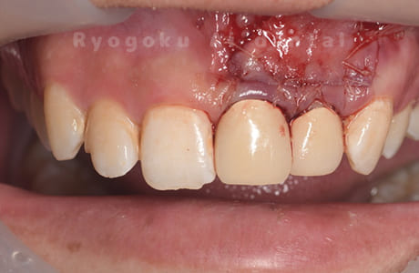 歯根端切除法術直後