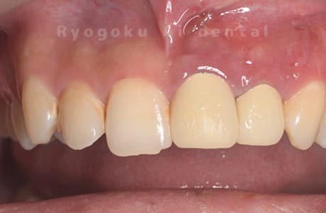 歯根端切除法術後